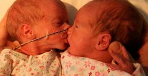 Segítsük együtt az ikerbabákat! – TTTS